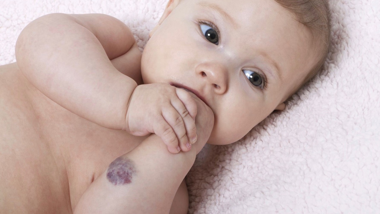 Kleiner Säugling mit Blutschwämmchen am Arm